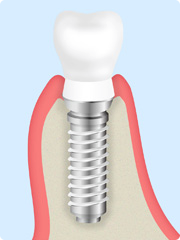 インプラントの構造
