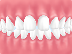 【空隙歯列（くうげきしれつ）】